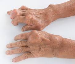 Artitis gotosa
