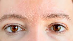 dermatitis facial