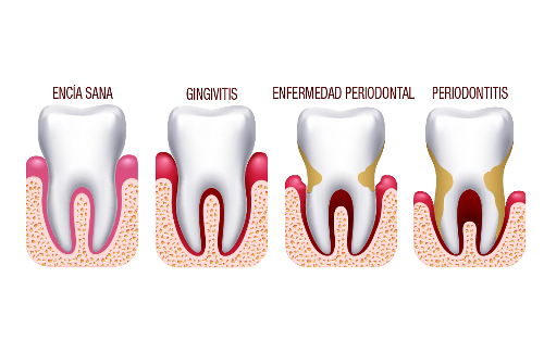 enfermedad periodental