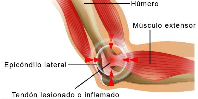 epicondilitis