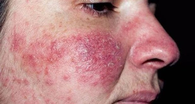 rosacea estadio III
