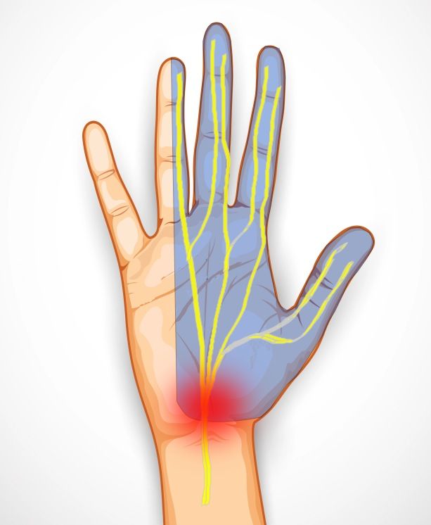 sindrome tunel carpiano