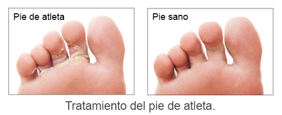 Tratamiento pié de atleta